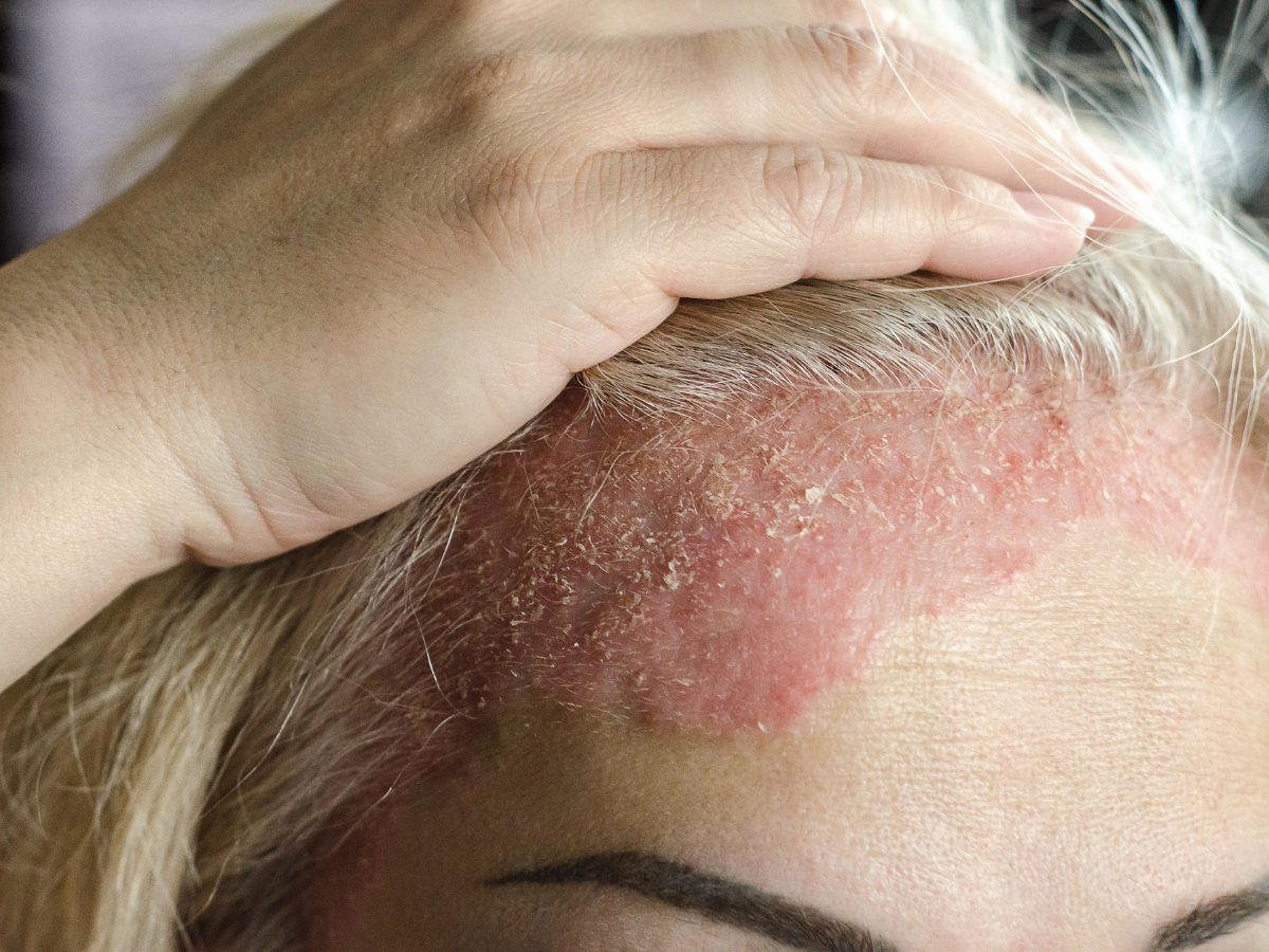 Como ajudar o doente a controlar o eczema seborreico no couro cabeludo?